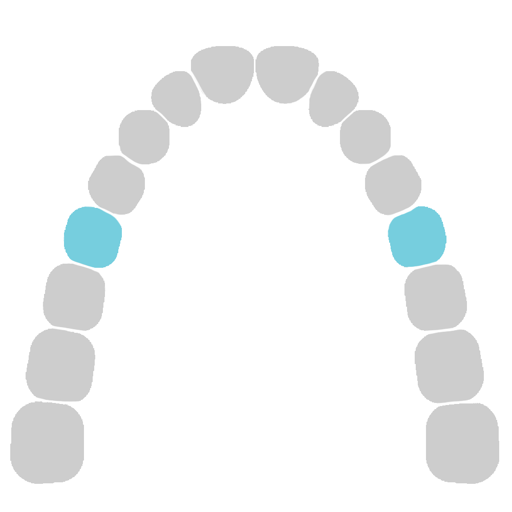 Third Molars upper table